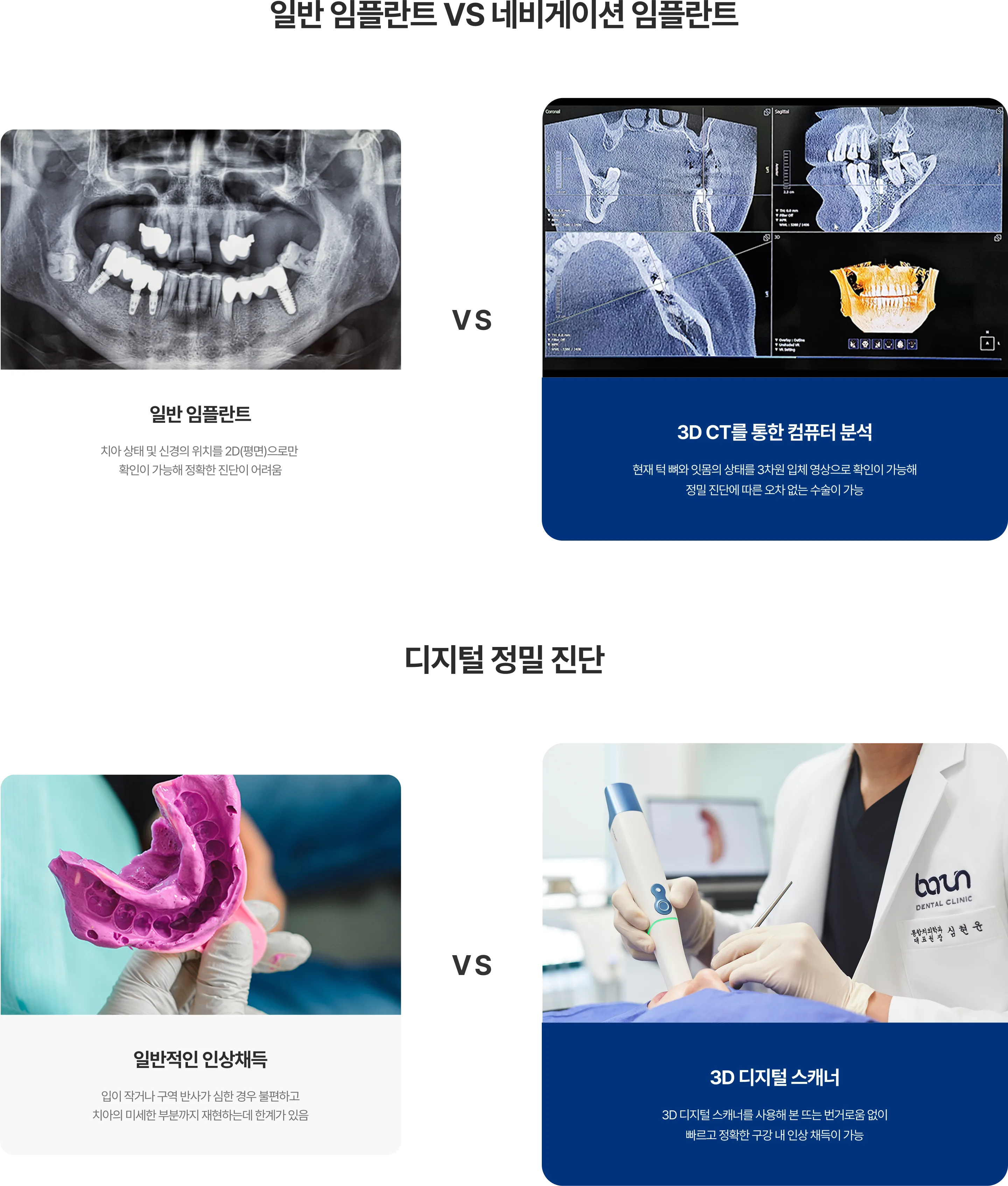 일반 임플란트 진단 시 사용되는 2D 파노라마 X-ray 이미지와 네비게이션 임플란트 진단을 위한 3D CT 및 시뮬레이션 이미지, 기존 방식의 치아 인상 채득을 위한 트레이와 인상재, 그리고 구강 내 치아를 정밀하게 스캔하는 3D 디지털 스캐너 사용 모습 비교