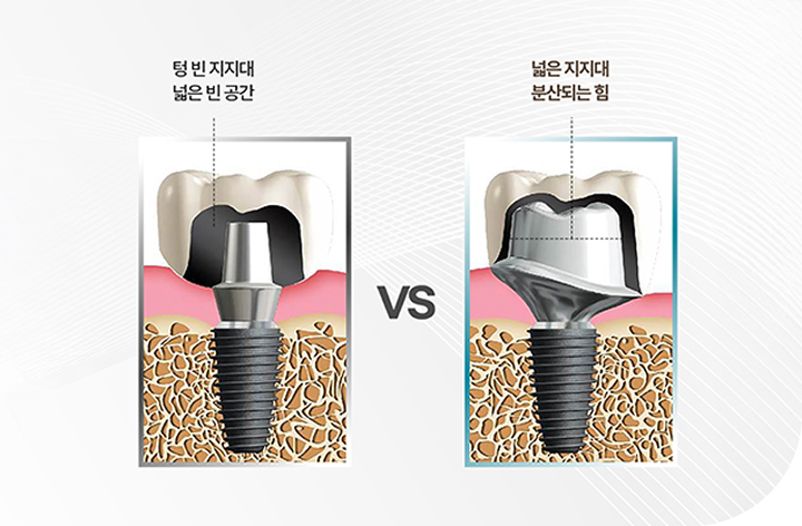 선별된 우수 골이식재의 활용