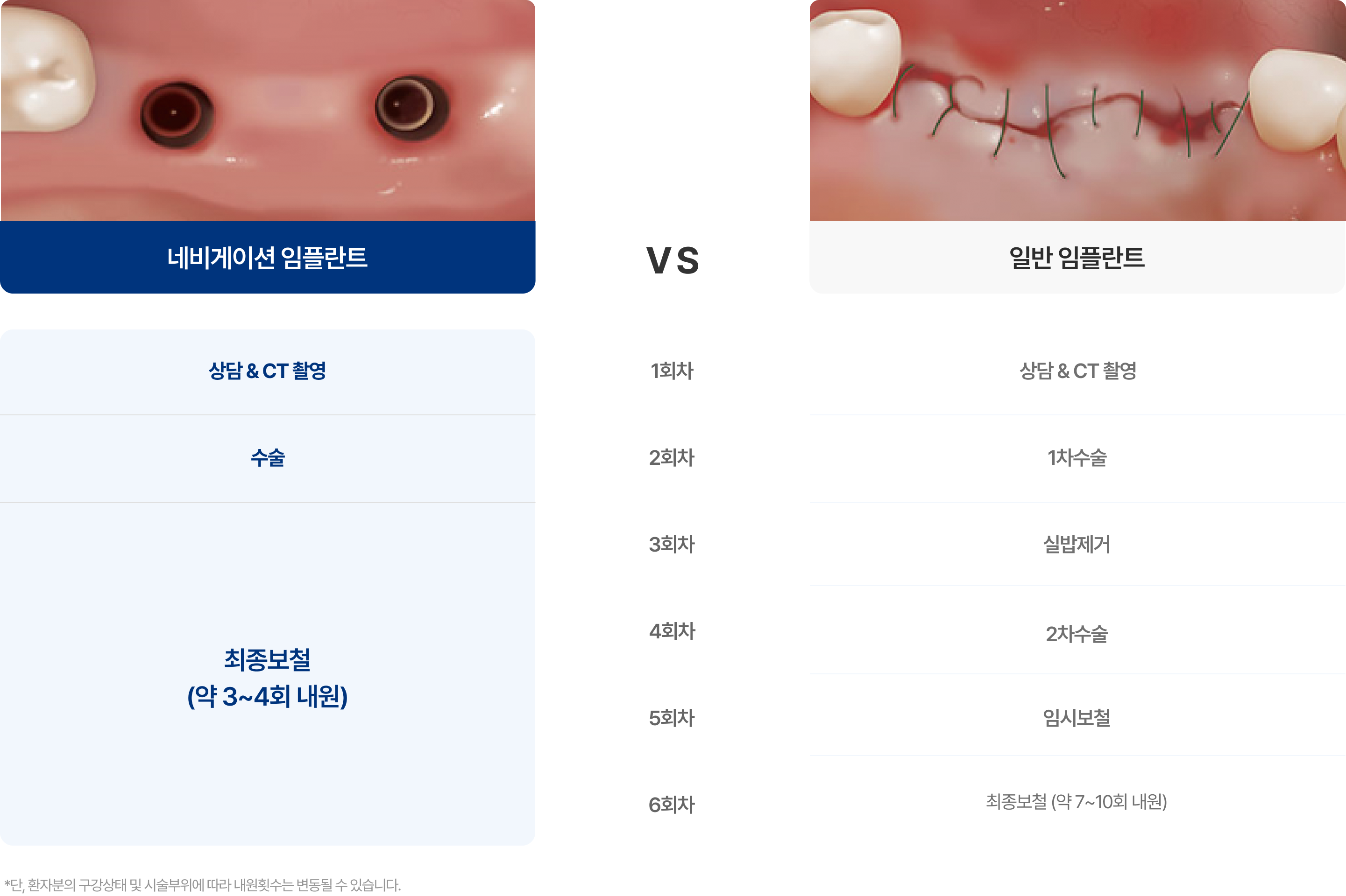 네비게이션, 일반 임플란트의 차이