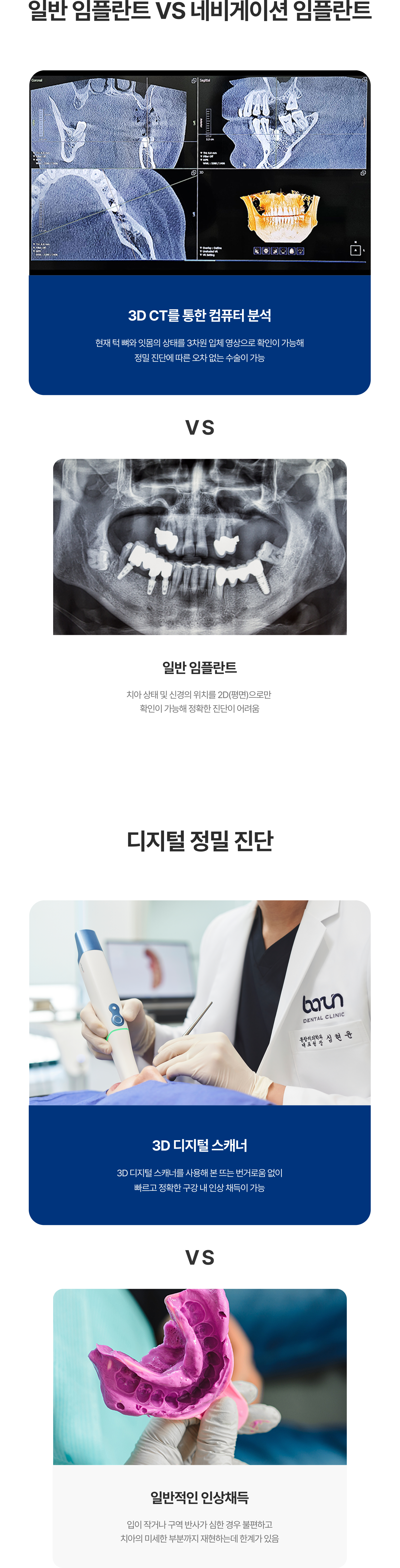 일반과 네비게이션 임플란트 비교, 디지털 정밀진단